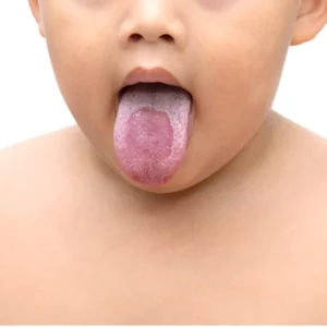 برفک دهان نوزاد چیست ، علت و راه درمان