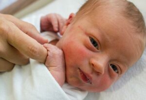 زردی نوزاد چیست؟ علائم و درمان آن