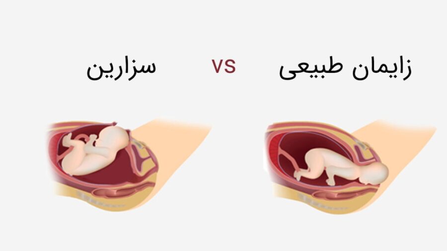 فرق زایمان طبیعی و سزارین