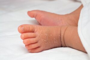 علت خشکی پوست نوزاد