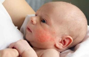 حساسیت نوزاد به شیر خشک