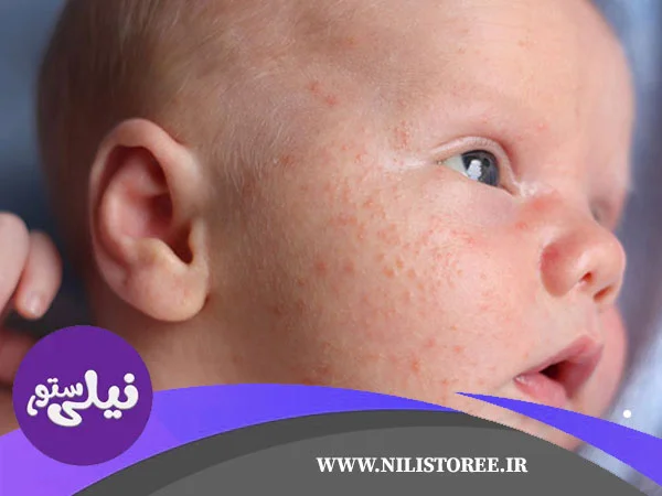 تجربیات مادران در مواجهه با مشکلات رایج نوزادان